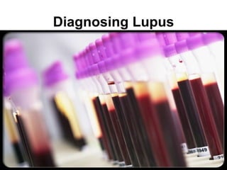 Diagnosing Lupus
 