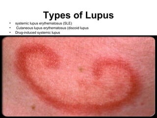 Types of Lupus
•   systemic lupus erythematosus (SLE)
•    Cutaneous lupus erythematosus (discoid lupus
•   Drug-induced systemic lupus
 