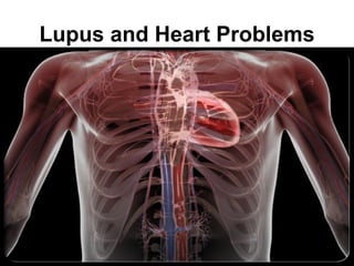 Lupus and Heart Problems

                           . •
 