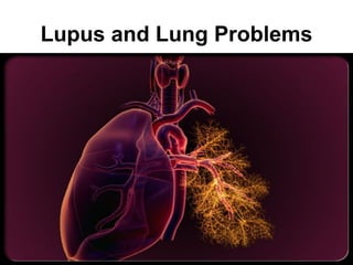 Lupus and Lung Problems
 
