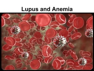 Lupus and Anemia
 