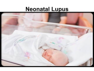 Neonatal Lupus
 
