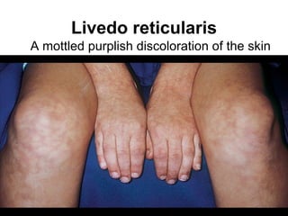 Livedo reticularis
A mottled purplish discoloration of the skin
 