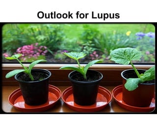 Outlook for Lupus
 