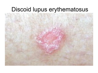 Discoid lupus erythematosus
 