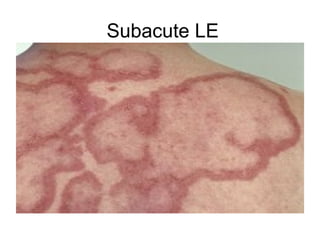 Subacute LE
 