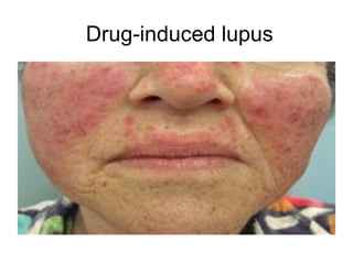 Drug-induced lupus
 