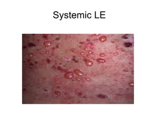 Systemic LE
 