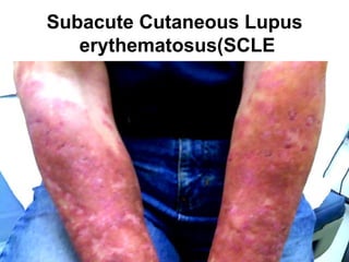 Subacute Cutaneous Lupus
   erythematosus)SCLE
 