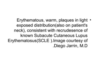 Erythematous, warm, plaques in light •
    exposed distribution(also on patient's
   neck), consistent with recrudesence of
       known Subacute Cutaneous Lupus
Erythematosus(SCLE ).Image courtesy of
                        .Diego Jarrin, M.D
 