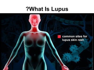 ?What Is Lupus
 