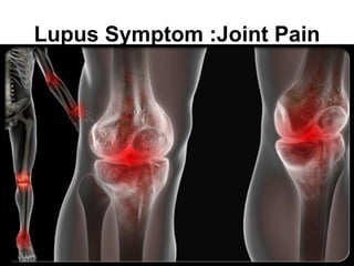 Lupus Symptom :Joint Pain
 