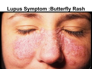 Lupus Symptom :Butterfly Rash
 
