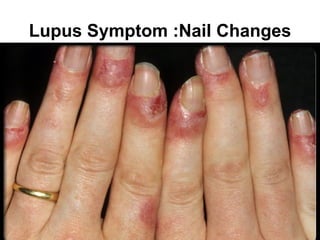Lupus Symptom :Nail Changes
 