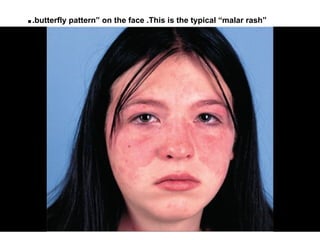 ..butterfly pattern” on the face .This is the typical ”malar rash”
 