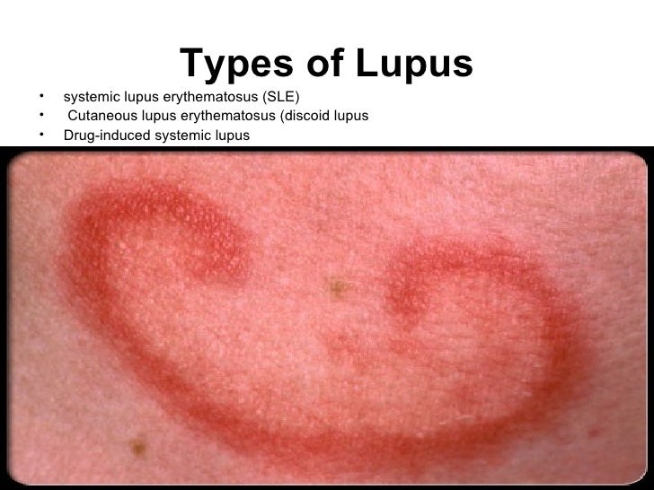 Acute systemic lupus erythematosus
