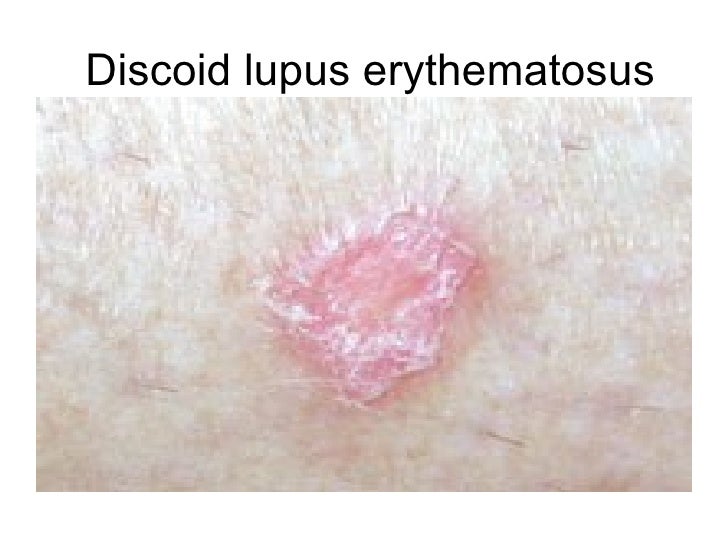 gabapentin and drug induced lupus
