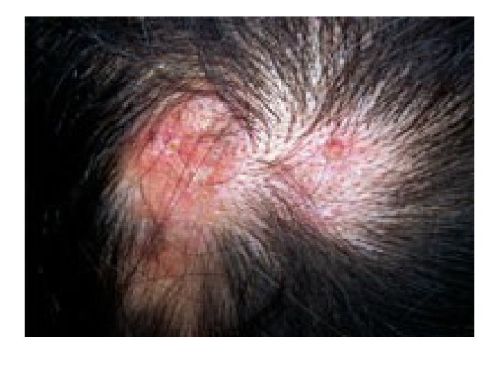 Acute Systemic Lupus Erythematosus