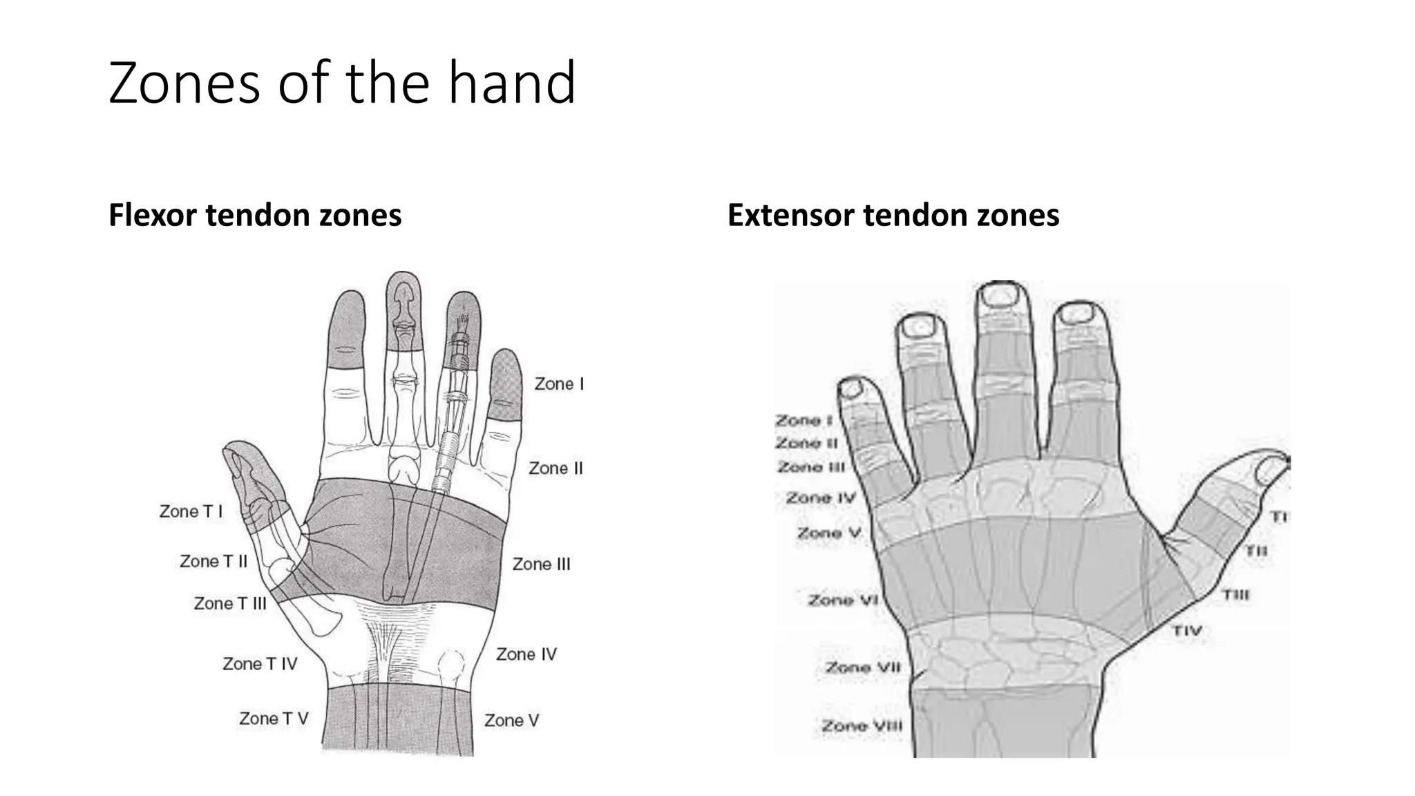 Acute Tendon injury of the Hand and its Repair.pptx | Death, Injury, or ...