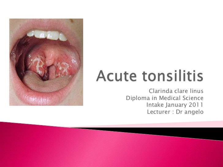 Acute tonsilitis
