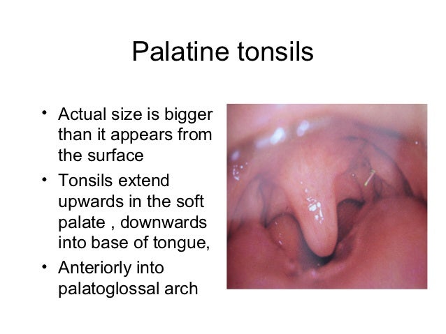 Acute tonsillitis