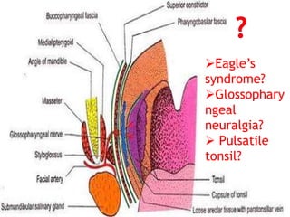Eagle’s
syndrome?
Glossophary
ngeal
neuralgia?
 Pulsatile
tonsil?
 