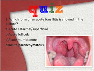 1. Which form of an acute tonsillitis is showed in the
picture?
a)Acute catarrhal/superficial
b)Acute follicular
c)Acute membranous
d)Acute parenchymatous
 