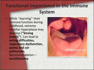 Functional Importance in the Immune
System
• While ‘’learning’’ their
immune function during
childhood, extreme
tonsillar hyperplasia may
develop (‘’kissing
tonsils’’). Can lead to
eating difficulties,
respiratory dysfunction,
apnea and cor
pulmonale.
Recommendation –
tonsillectomy.
 