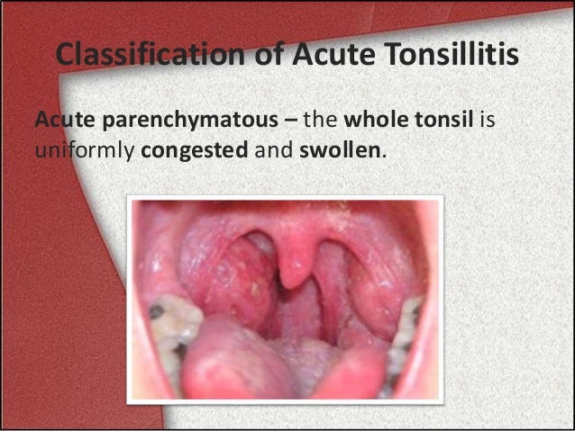 Acute Tonsillitis