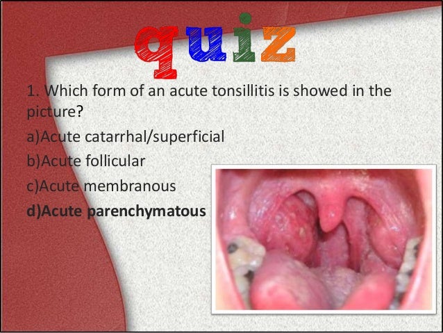 Acute tonsillitis