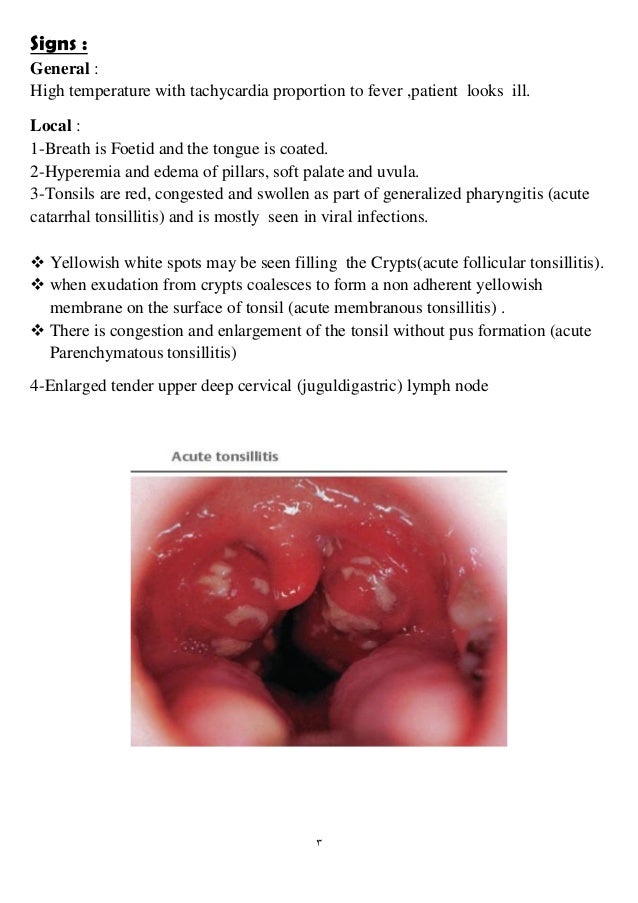 Acute tonsillitis