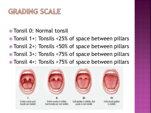 Tonsillitis Grading Scale tonsillitis-grading-scale
