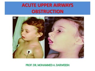 ACUTE UPPER AIRWAYS
OBSTRUCTION
PROF. DR. MOHAMMEDA. DARWEESH
 
