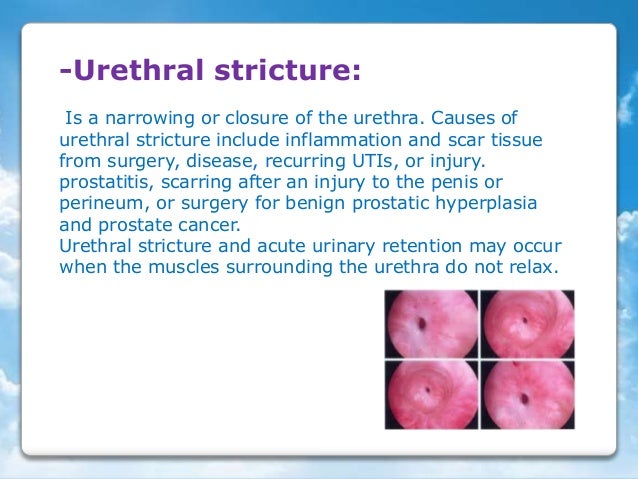Acute urinary retintion