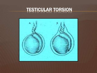 TESTICULAR TORSION
 