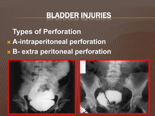 BLADDER INJURIES
Types of Perforation
 A-intraperitoneal perforation
 B- extra peritoneal perforation
 