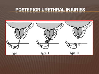 POSTERIOR URETHRAL INJURIES
 
