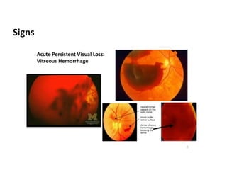 Decreases Visual Sign Acute visual loss | PPTX