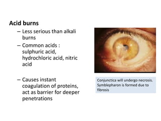 Acute visual loss | PPTX