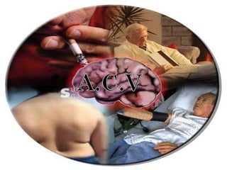 Acv | PPT
