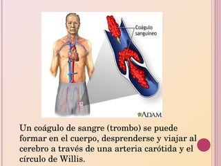 Un coágulo de sangre (trombo) se puede formar en el cuerpo, desprenderse y viajar al cerebro a través de una arteria carótida y el círculo de Willis. 