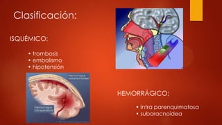 Clasificación:
ISQUÉMICO:
HEMORRÁGICO:
• trombosis
• embolismo
• hipotensión
• intra parenquimatosa
• subaracnoidea
 