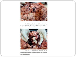 Accidente cerebrovascular