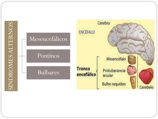 SINDROMESALTERNOS
Mesencefálicos
Pontinos
Bulbares
 