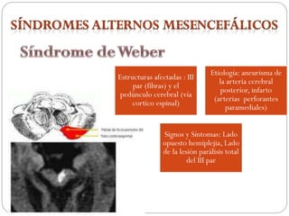 Estructuras afectadas : III
par (fibras) y el
pedúnculo cerebral (vía
cortico espinal)
Etiología: aneurisma de
la arteria cerebral
posterior, infarto
(arterias perforantes
paramediales)
Signos y Síntomas: Lado
opuesto hemiplejia, Lado
de la lesión parálisis total
del III par
 