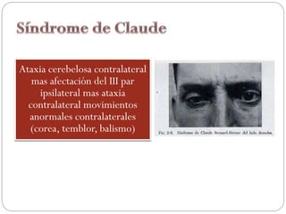 Ataxia cerebelosa contralateral
mas afectación del III par
ipsilateral mas ataxia
contralateral movimientos
anormales contralaterales
(corea, temblor, balismo)
 