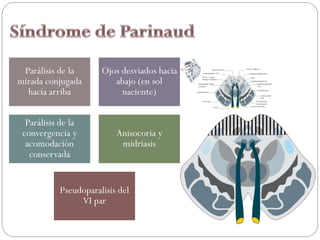 Parálisis de la
mirada conjugada
hacia arriba
Ojos desviados hacia
abajo (en sol
naciente)
Parálisis de la
convergencia y
acomodación
conservada
Anisocoria y
midriasis
Pseudoparalisis del
VI par
 