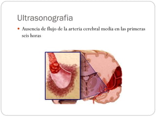 Ultrasonografia
 Ausencia de flujo de la arteria cerebral media en las primeras
seis horas
 