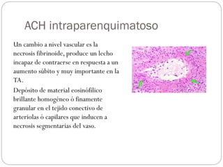 ACH intraparenquimatoso
Un cambio a nivel vascular es la
necrosis fibrinoide, produce un lecho
incapaz de contraerse en respuesta a un
aumento súbito y muy importante en la
TA.
Depósito de material eosinófilico
brillante homogéneo ó finamente
granular en el tejido conectivo de
arteriolas ó capilares que inducen a
necrosis segmentarias del vaso.
 