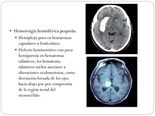  Hemorragia hemisférica pequeña
 Hemiplejia pura en hematomas
capsulares o lenticulares.
 Defecto hemisensitivo con poca
hemiparesia en hematomas
talámicos, los hematoma
talamicos suelen asociarse a
alteraciones oculomotoras, como
desviación forzada de los ojos
hacia abajo por por compresión
de la región tectal del
mesencéfalo.
 
